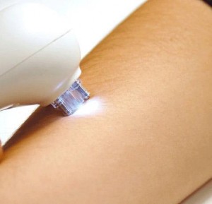 depilacion-laser-granada