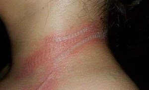 quemaduras_cuello_movil_n-672xXx80