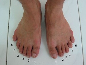 seis_dedos_en_la_mano