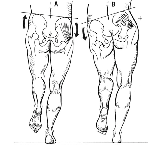 prueba de detección sindrome culo muerto