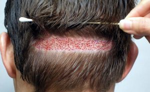 promocion-implante-capilar-con-la-tecnica-fue-D_NQ_NP_254915-MLA25336453530_022017-F