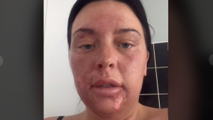 Tiktok mujer se quema la cara escalfando un huevo