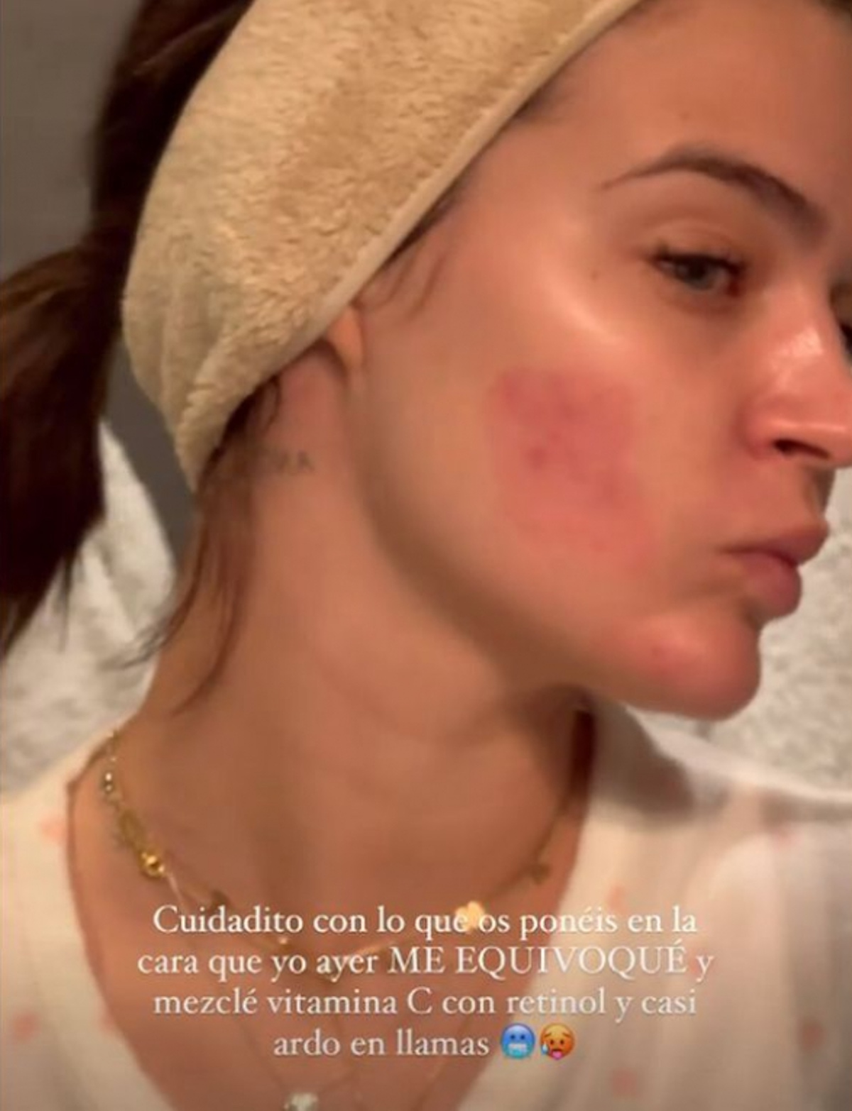 Imagen de Laura Escanes con una abrasión en el rostro.