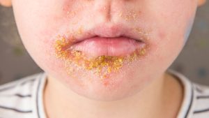 Impétigo en niños.