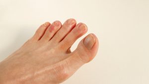 Sabañones en los pies