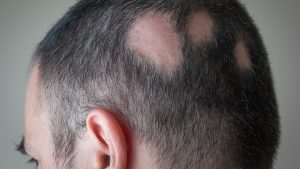 Ejemplo de alopecia areata