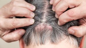 Cuero cabelludo sensible