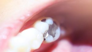 close up macro photo of Metall amalgam dental fillings