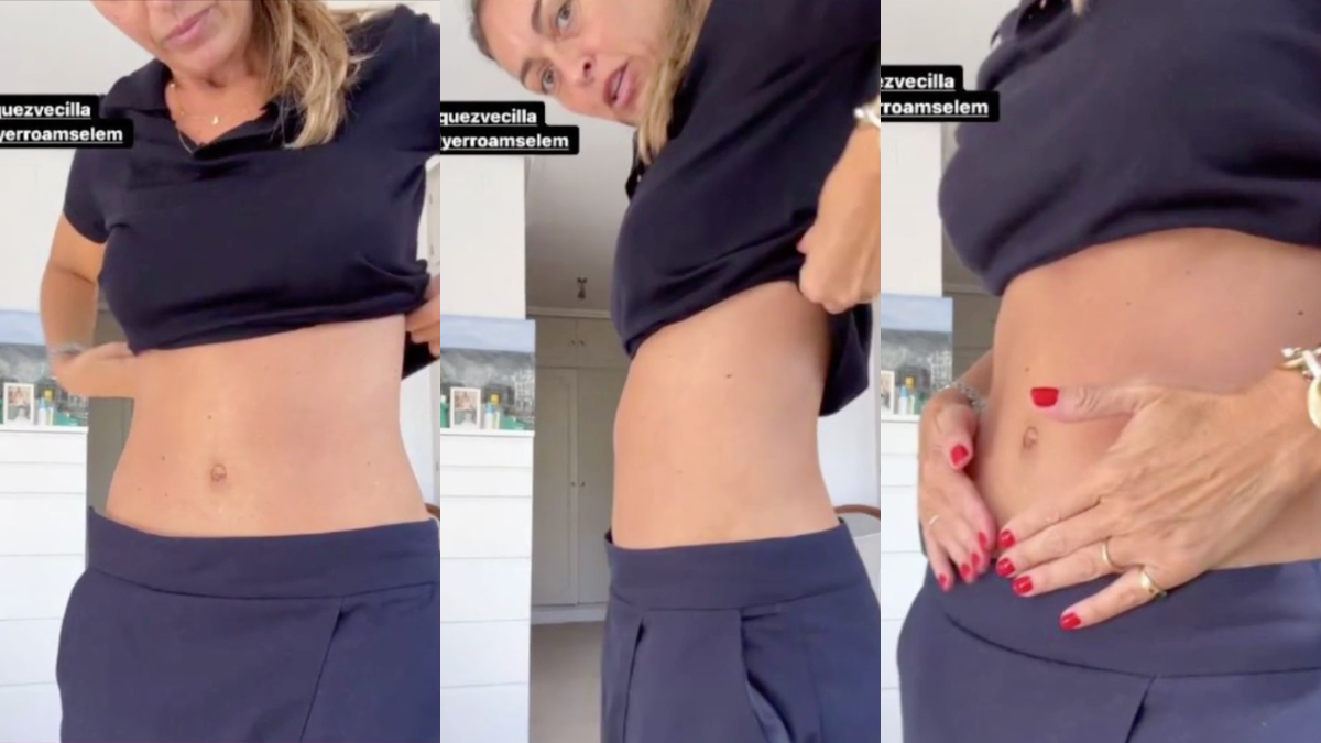 María Amores muestra el resultado de su abdominoplastia