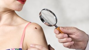 Dermatologist inspecting melanoma