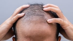 Tratamiento contra la calvicie